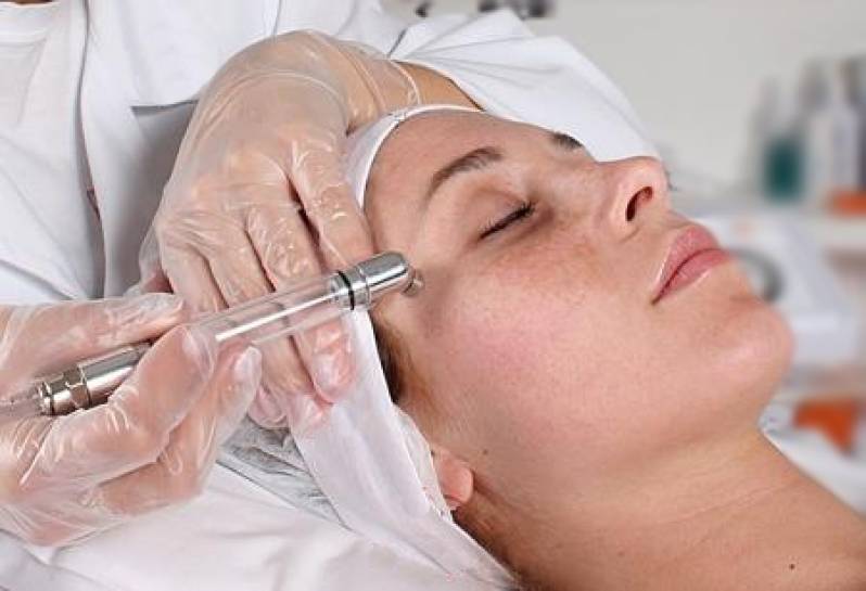 Dinarte | peeling químico